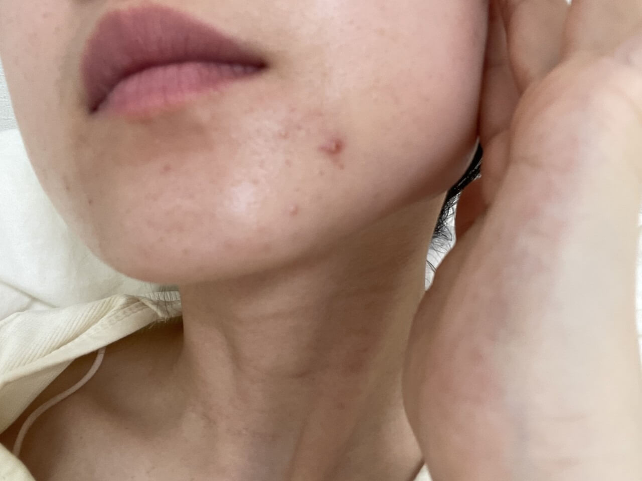 입주변 여드름 홈케어 방법을 설명하는 스킨케어 이미지로 살리실산 티트리 나이아신아마이드 성분이 입가 뾰루지 진정과 피지 조절에 도움을 주는 피부 관리 정보