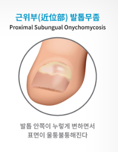 발톱무좀 없애는 방법 3