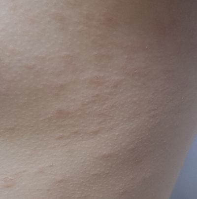 장미색 비강진 관리하는 방법