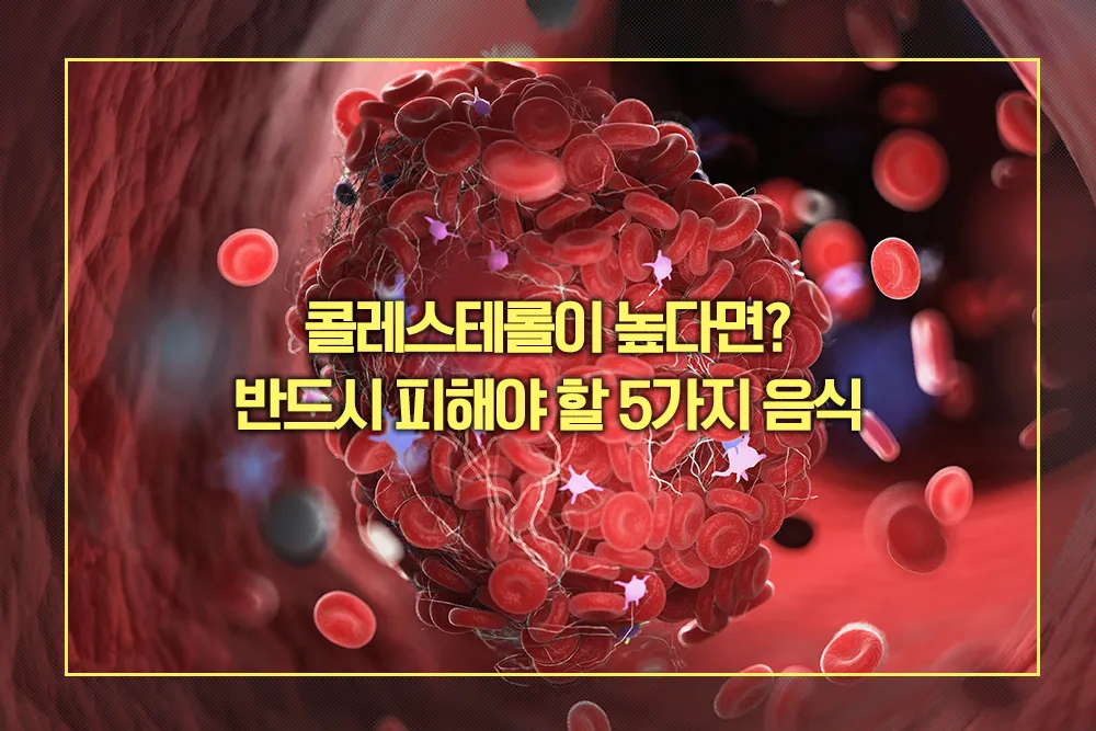 콜레스테롤 수치 높으면 반드시 피해야 할 5가지 음식