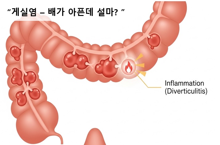 대장 벽에 주머니 형태의 게실과 염증이 발생한 모습