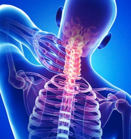 경추 추간판 탈출