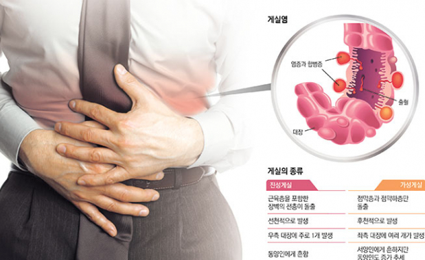 게실의종류와 배를 만지고 있는 환자의 사진