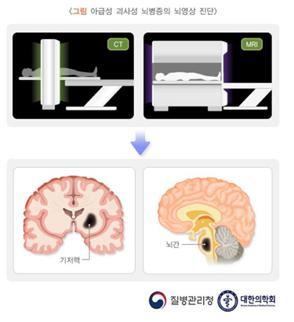 희귀질환 리이 증후군