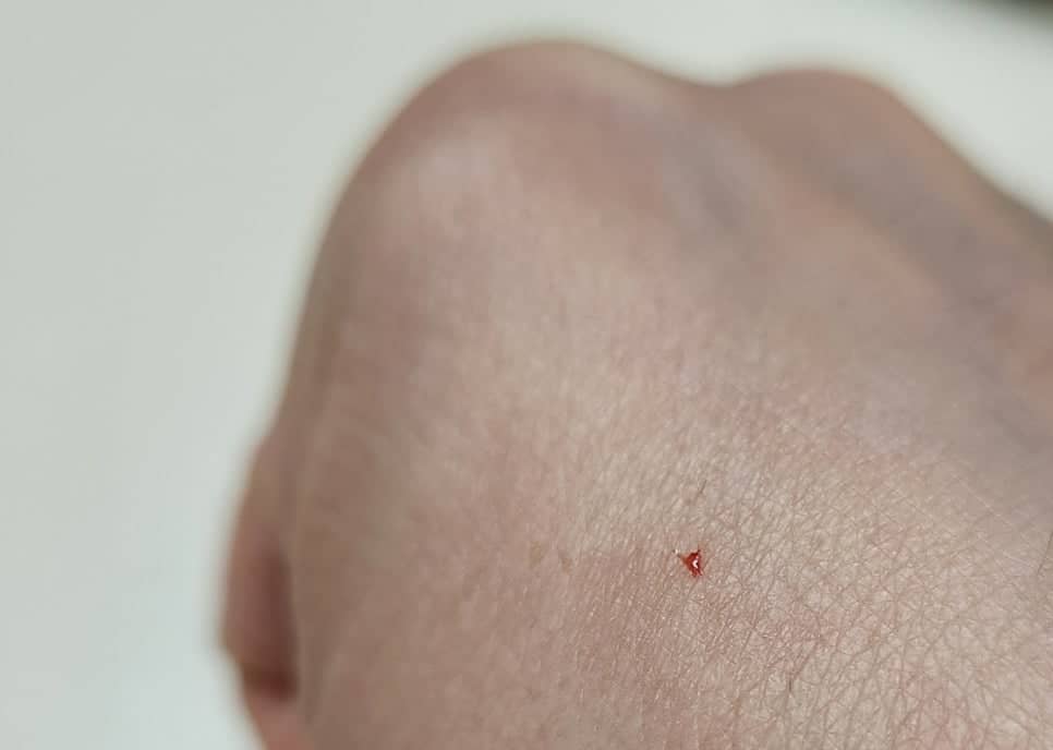 여드름 압출 도구 추천