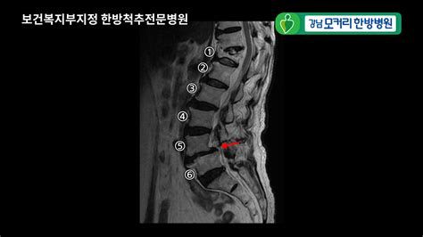 척추 협착증 원인