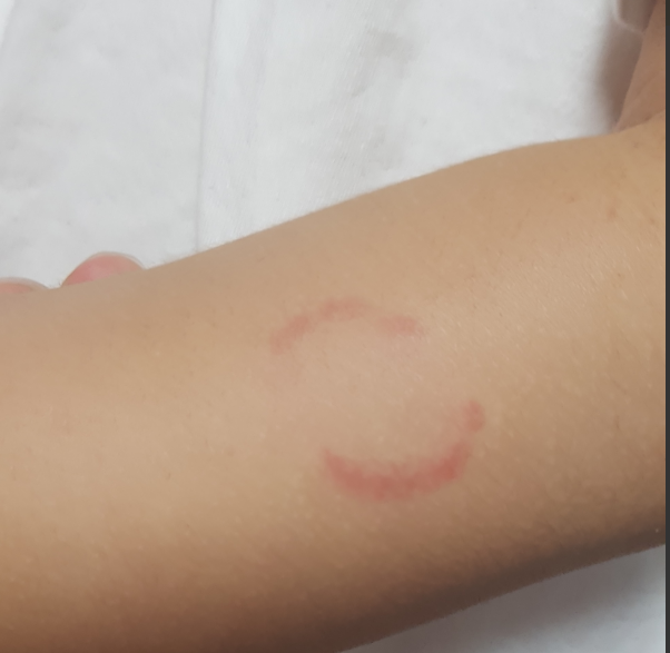 영아의 물린자국