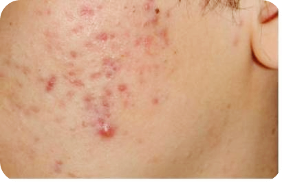 밀크시슬-효과-여드름개선