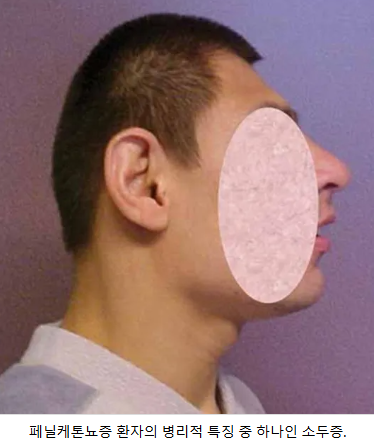 페닐알라닌_주의