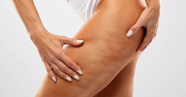 운동보다 빠른 셀룰라이트 제거 방법, 피부과 시술 효과는?