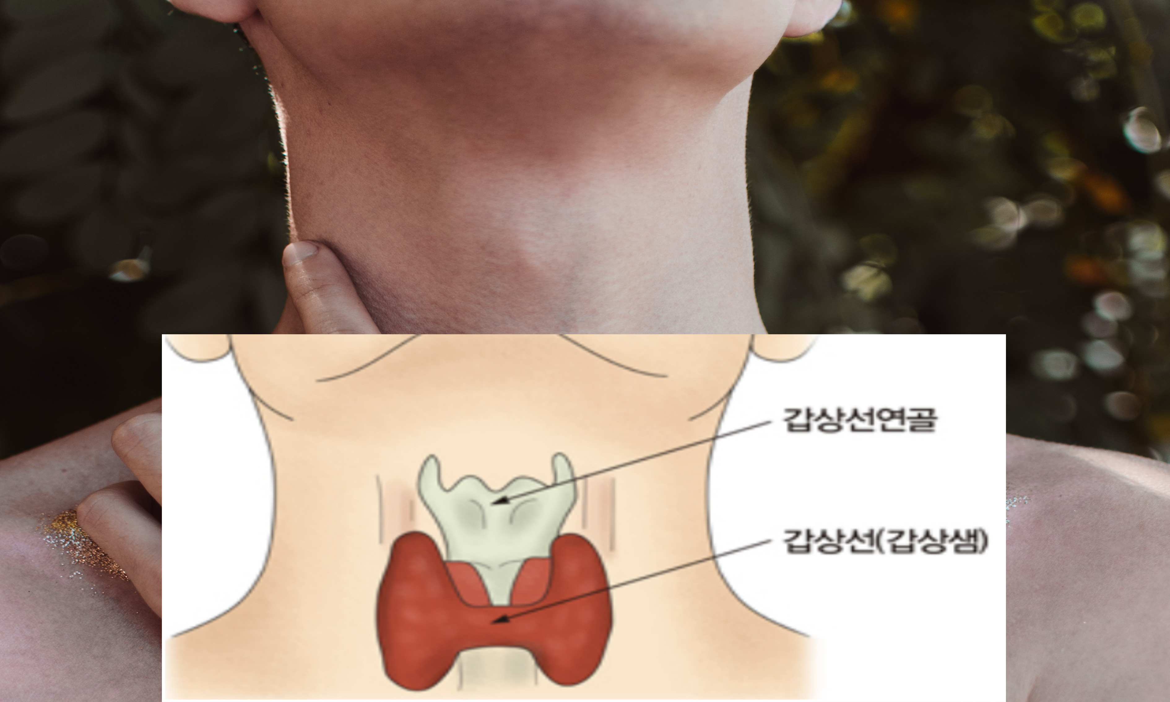 갑상선암