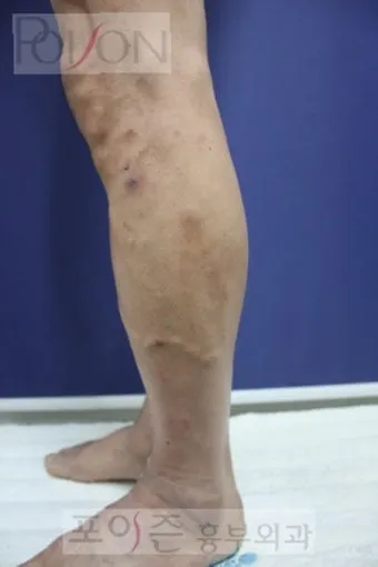 하지 정맥류 증상 치료방법과 예방 생활습관_10