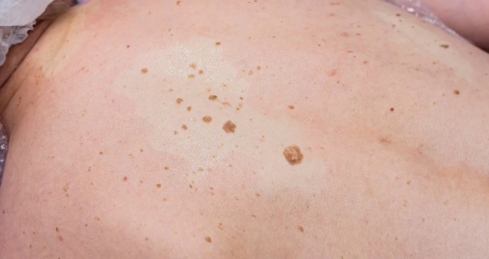 검버섯 없애는 방법