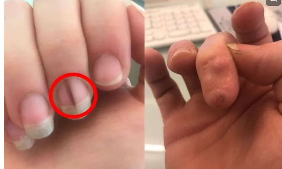 손톱에서 발견된 희미한 어두운선 그리고 절제하고 회복한 손톱모습-출처 켄트온라인캡쳐