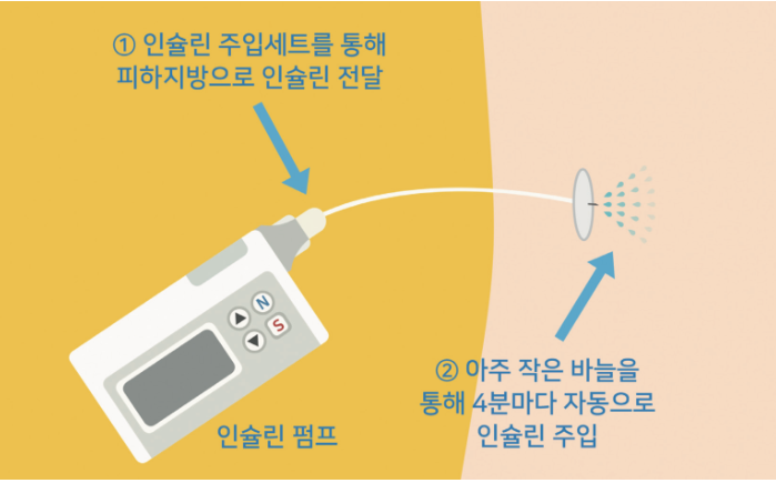 당뇨환자 인슐린펌프 작동원리