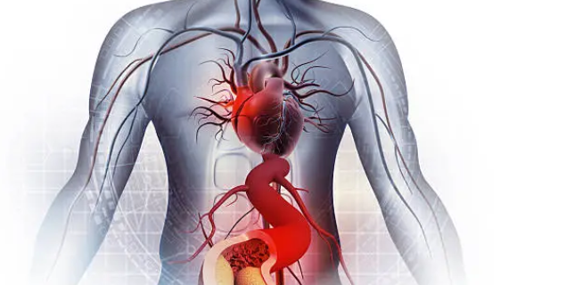 대동맥류 파열과 관련된 사진3