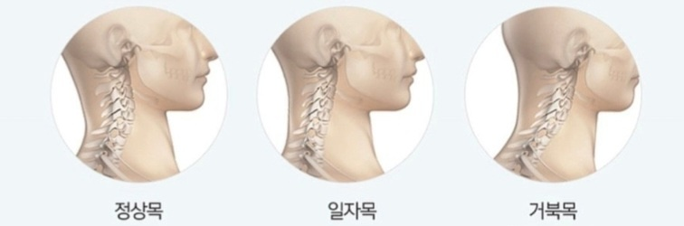 증상 에따른 목뼈의 위치 이미지