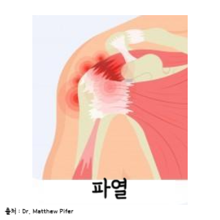 어깨통증원인