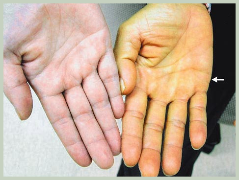 노란 손바닥 치료 방법