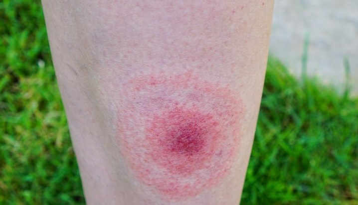 라임병-걸린-팔-다리