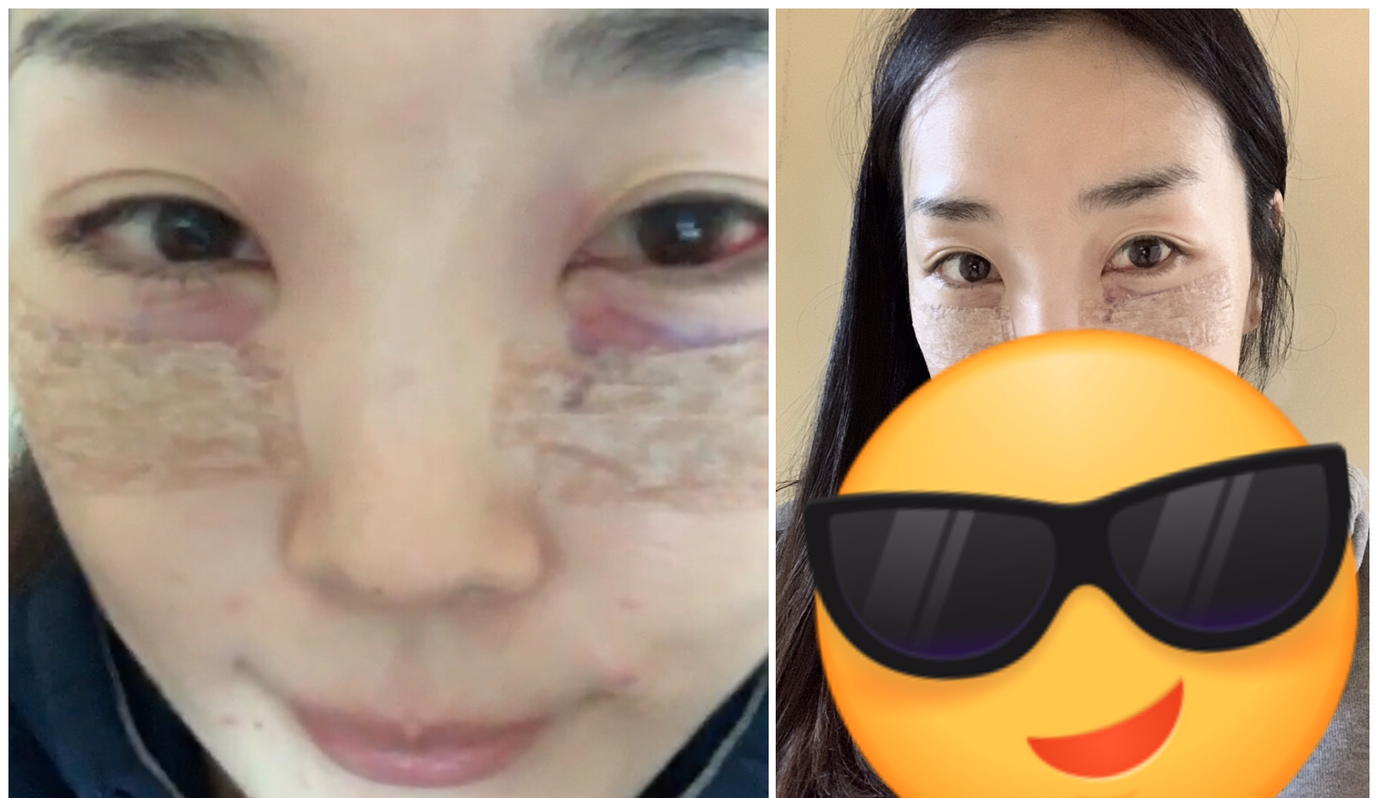 눈밑지방재배치 후기