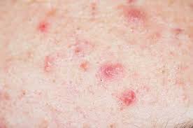 지루성 피부염 완치하려면