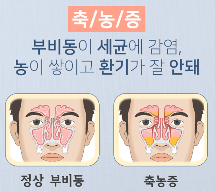 축농증