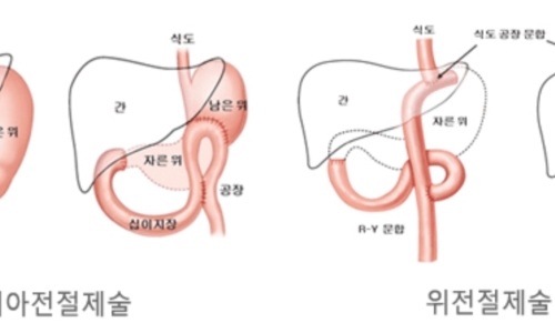 위암 이미지