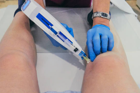 하지정맥류 치료