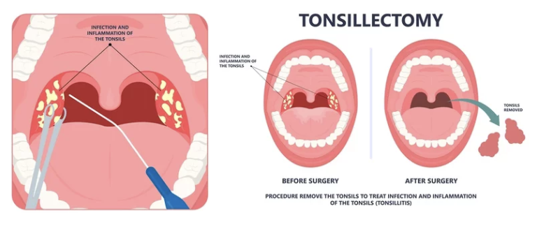 병원에서 편도결석 제거하는 방법