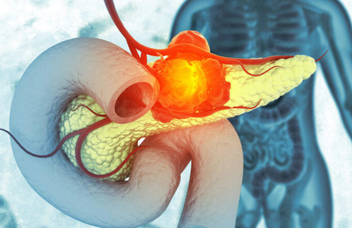 췌장암의 생존율