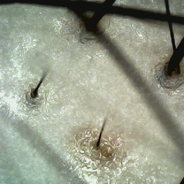 탈모 극복 프로젝트 - 정수리와 이마 사이 두피 모습이다.