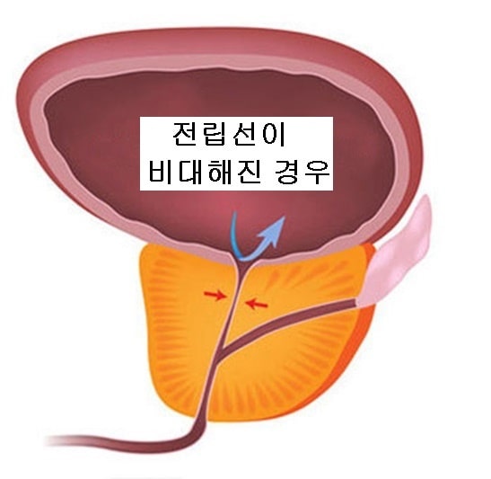전립선 비대증 치료방법