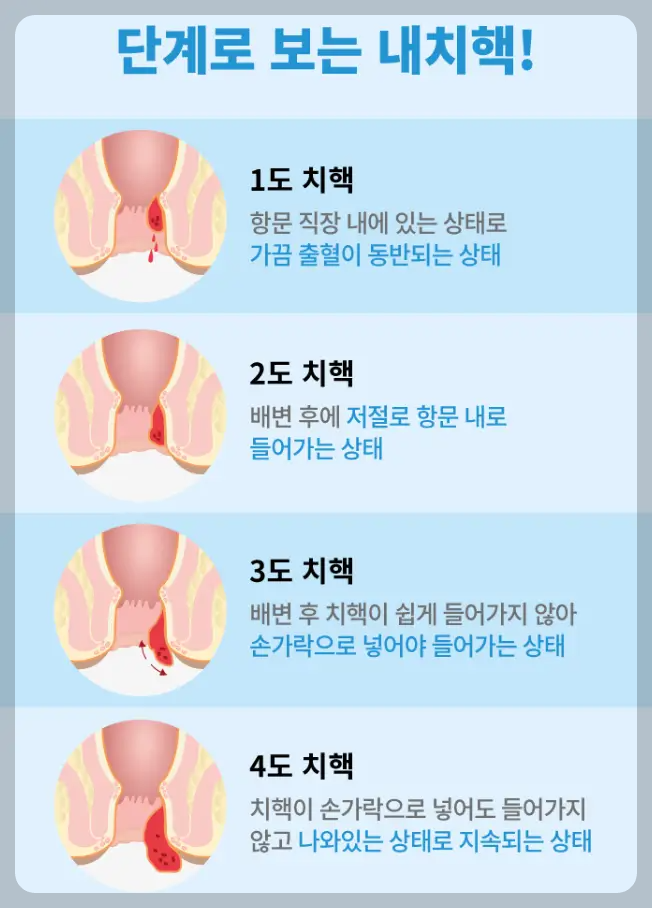 내치질 외치질 증상 차이