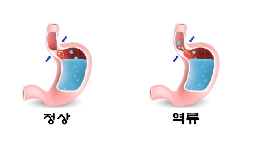 위-밸브-정상-비정상-사진