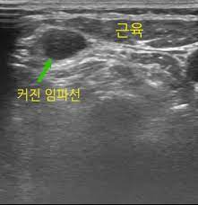 임파선염