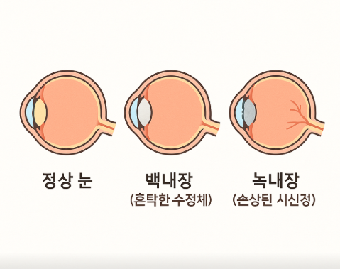 백내장, 녹내장 초기 증상