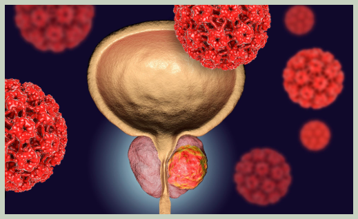 전립선암 초기 증상ㅇ