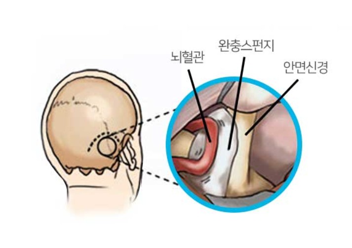 삼차 신경통 수술