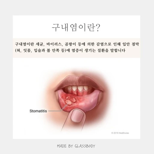 '구내염이란?'에 대하여 설명하는 이미지 입니다.