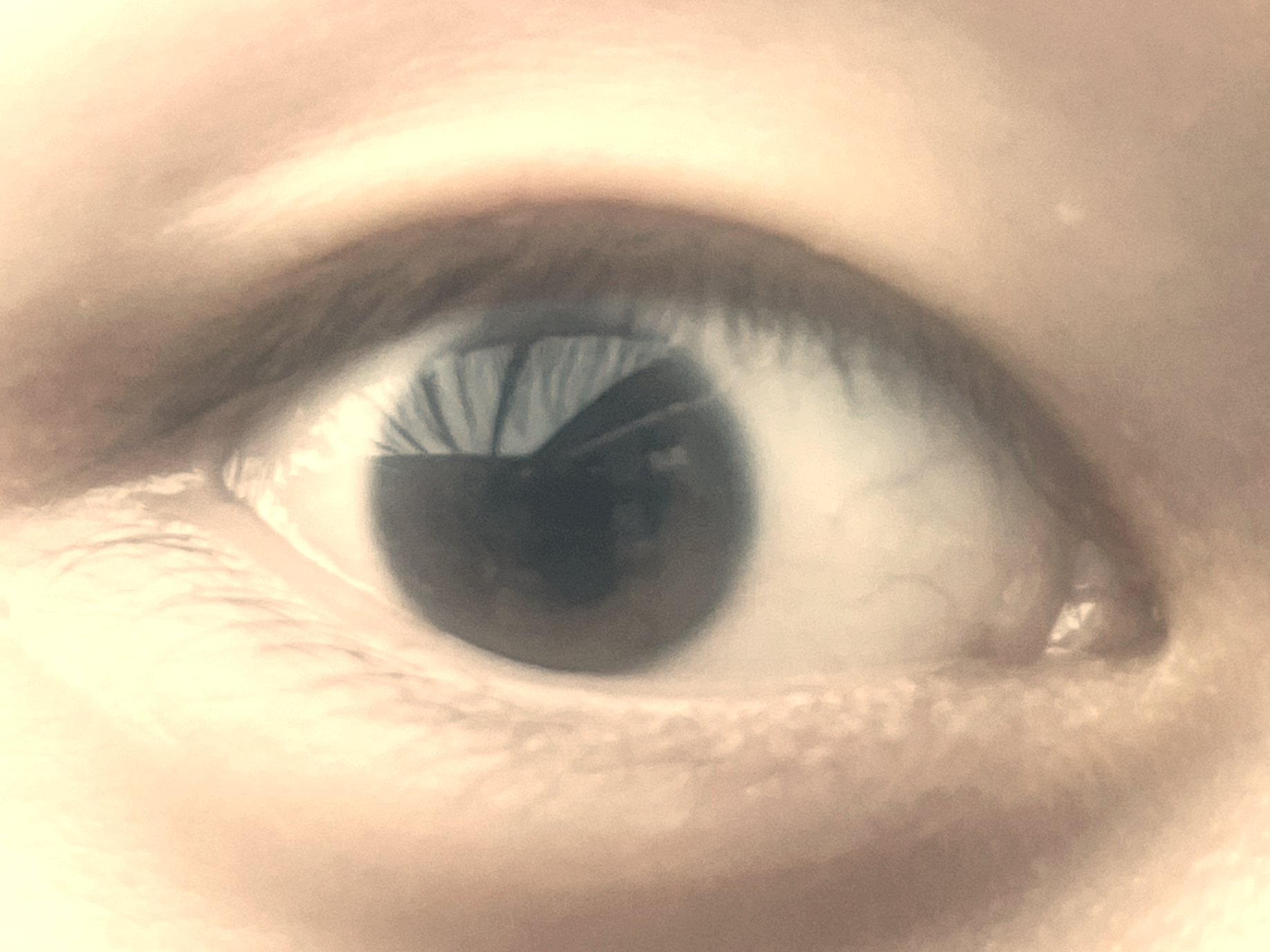 산동검사 후의 동공 모양. 흐리게 찍혔지만 동공이 확장된 것을 알 수 있다.