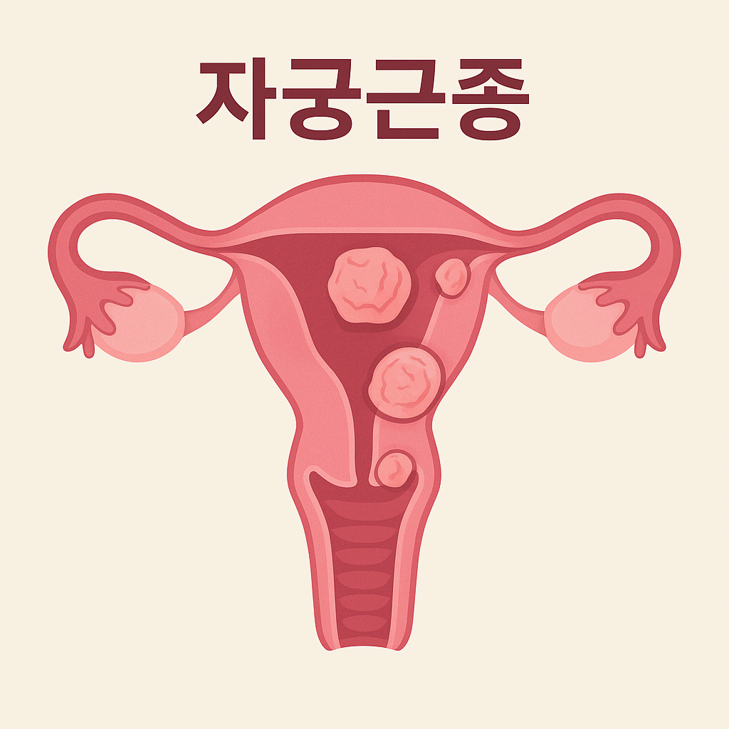 자궁근종