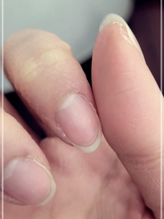 손가락 껍질 벗겨짐 원인과 해결 방법