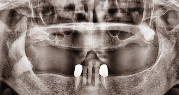 안산 임플란트 잘하는 치과