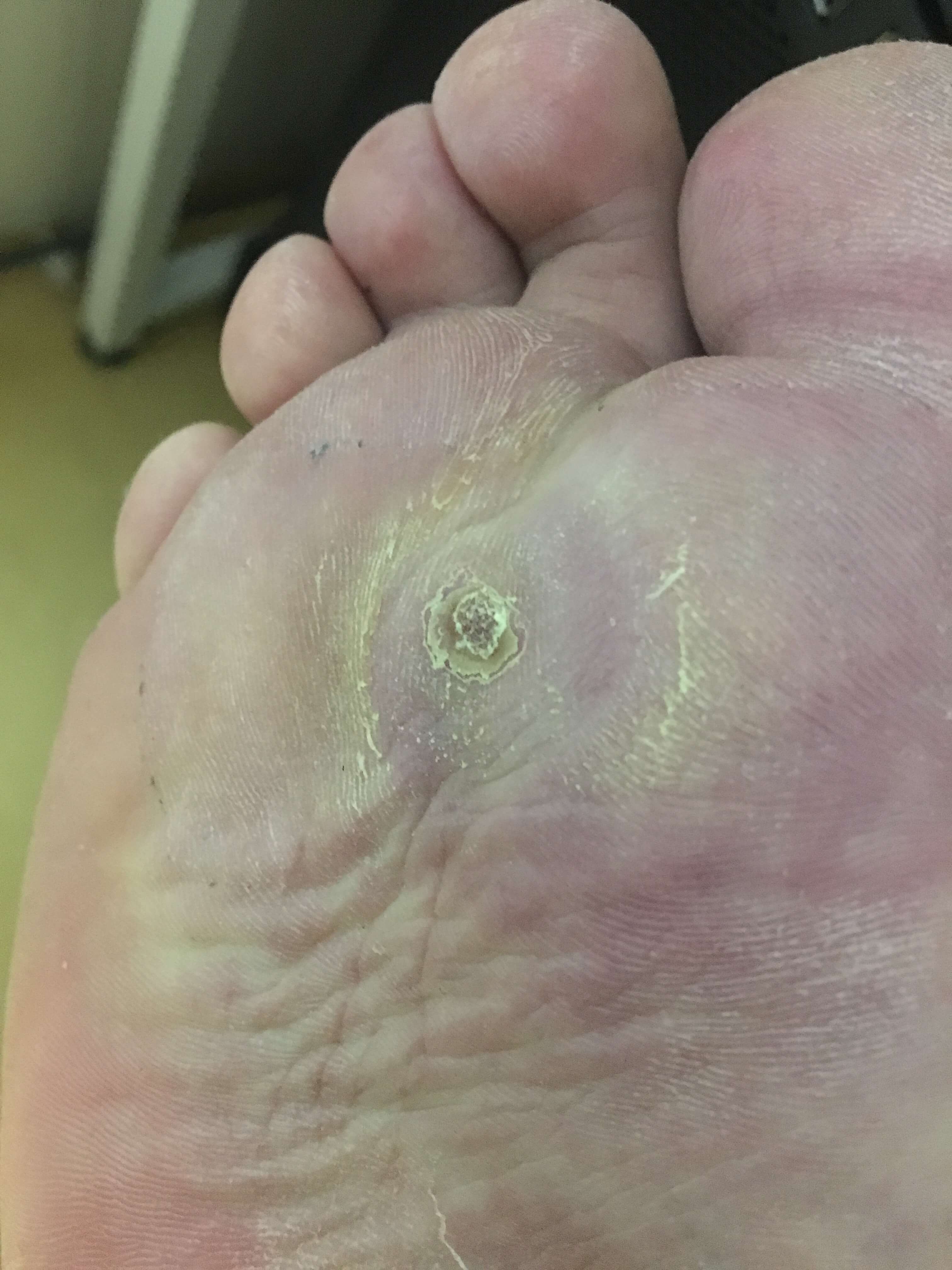 아주 작은 부분을 남겨두고 새살이 돋아났습니다.