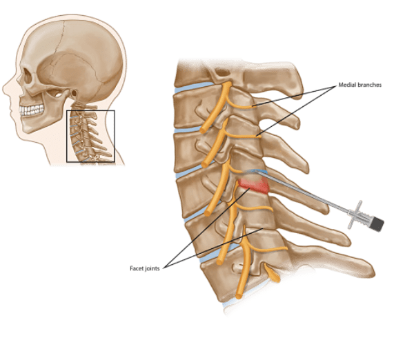 목디스크 치료방법