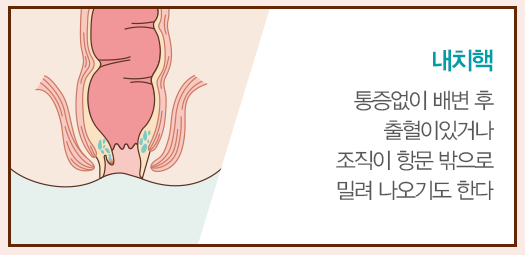 치질자가치료