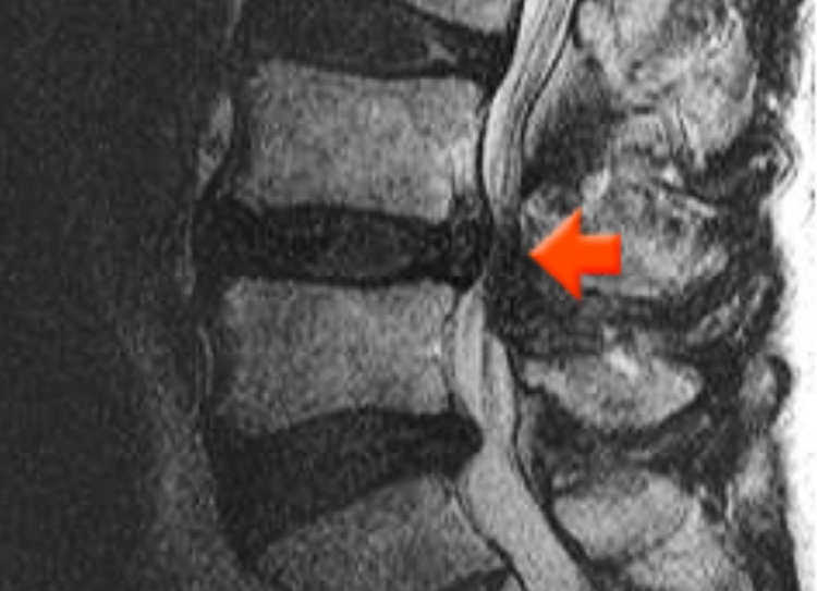 허리 삐끗했을때