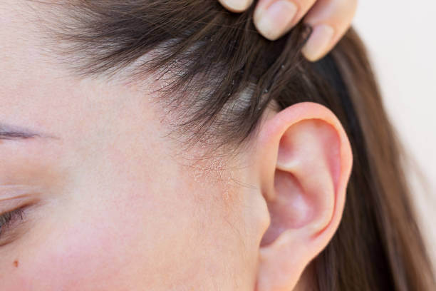 지루성 피부염, 인천에서 제대로 치료하려면?