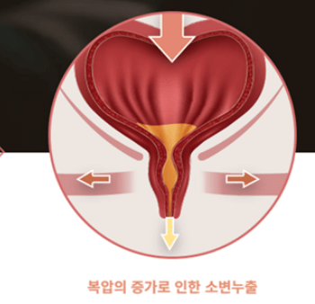 요실금_수술_후_회복기간_부작용_비용_보험적용여부